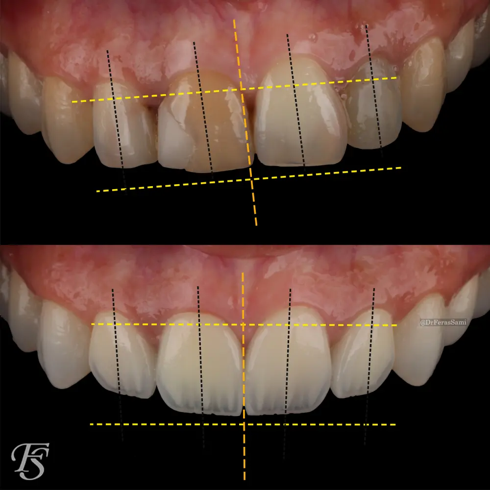Case 100 Zainab Hollywood Smile porcelain veneer transformation at TopDent