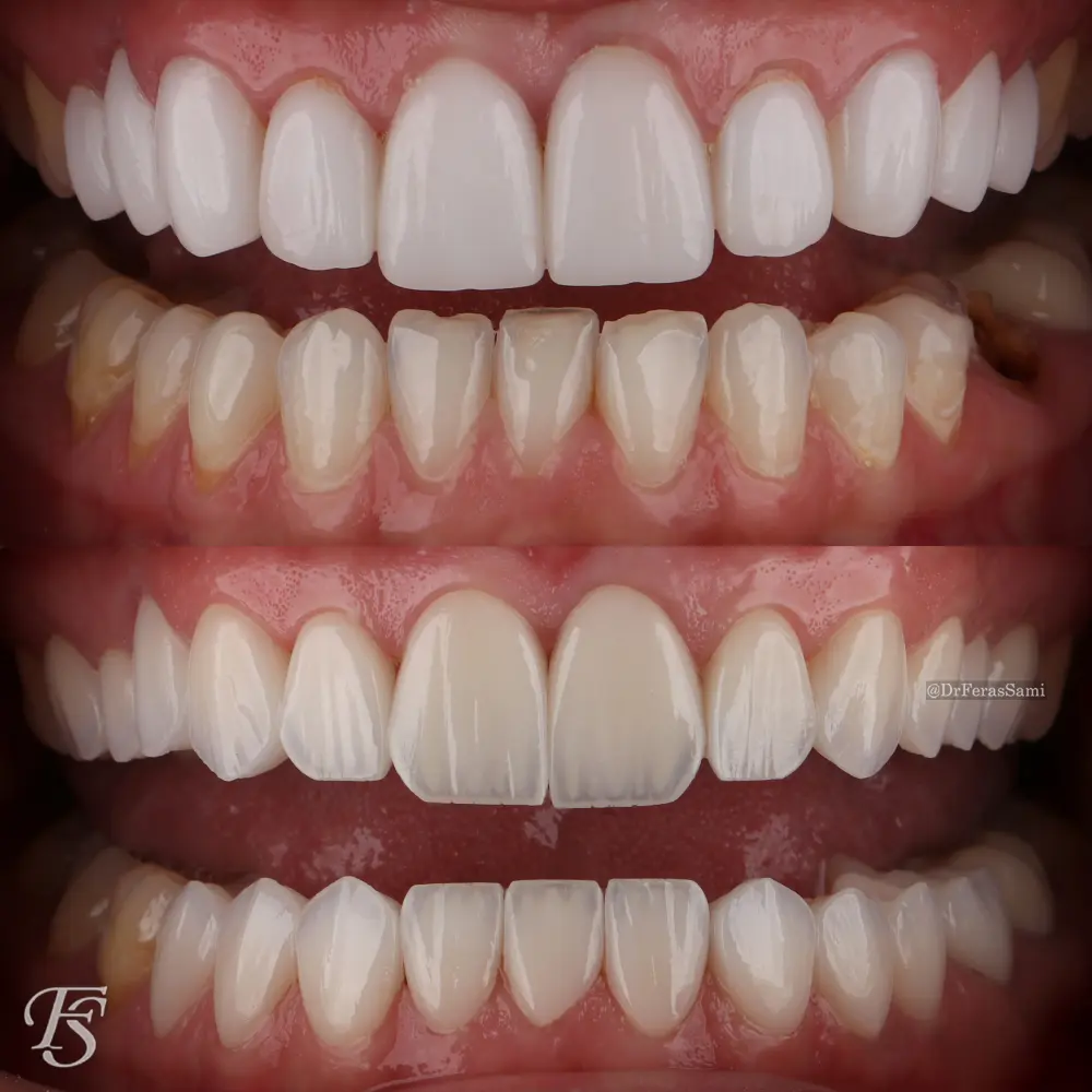 Case 119 Jessica aesthetic dental alignment and whitening result at TopDent
