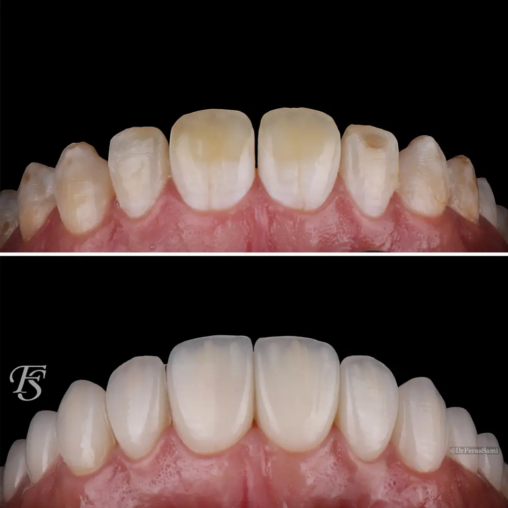 Case 49 Noor cosmetic restorative veneers at TopDent Dubai
