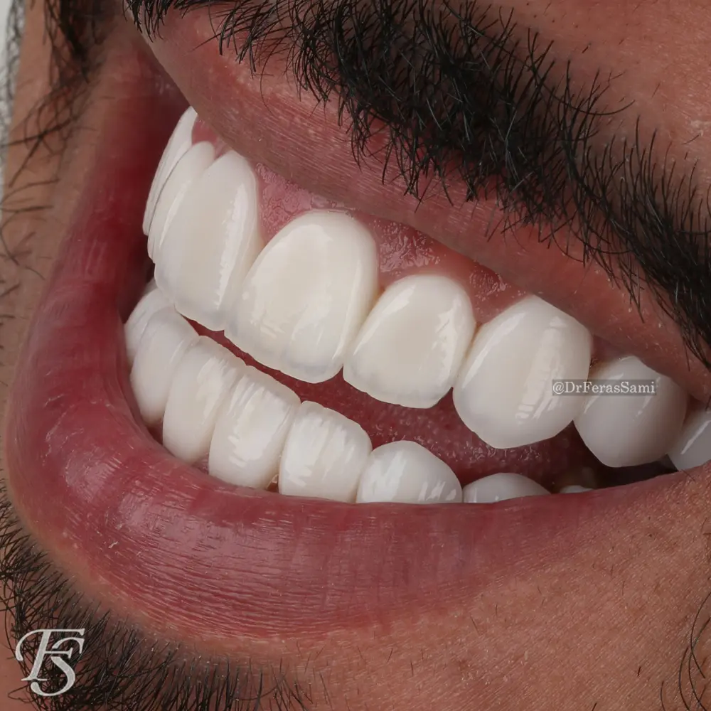 Mohammad Hollywood Smile result after porcelain veneer placement at TopDent Dubai