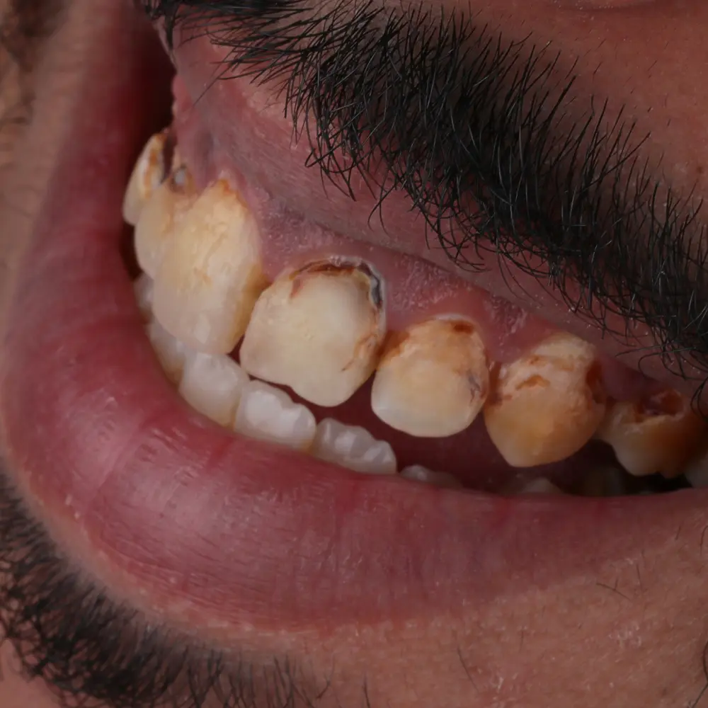Mohammad dental condition before cosmetic veneer makeover at TopDent Dubai