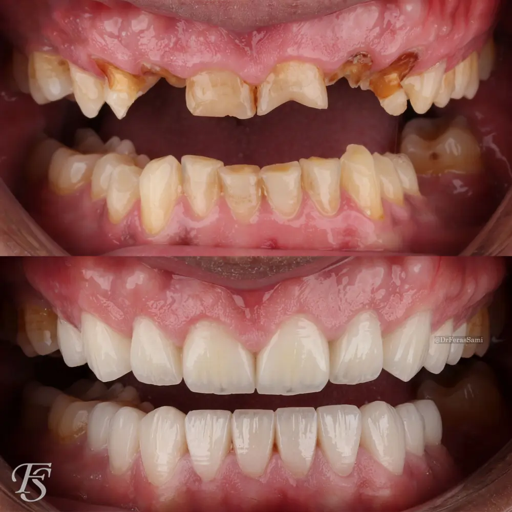 Case 86 Dawoud dental makeover and alignment result at TopDent Dubai