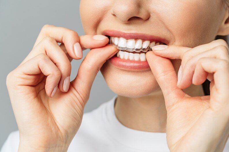 Invisalign transparent clear aligners held by orthodontist